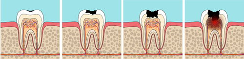 Tooth decay timeline